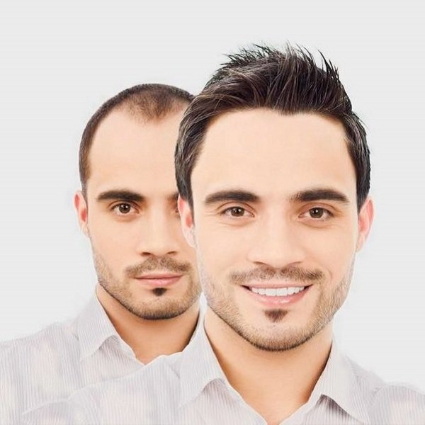 Hair Transplant