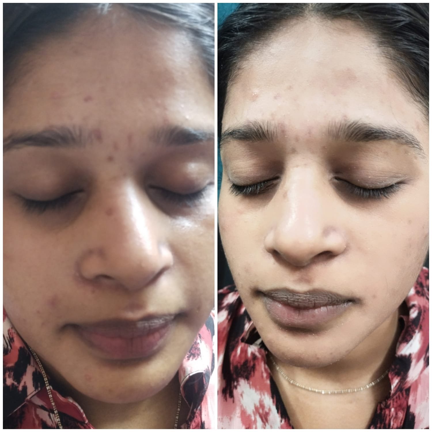 best skin treatment clinic in greater noida west