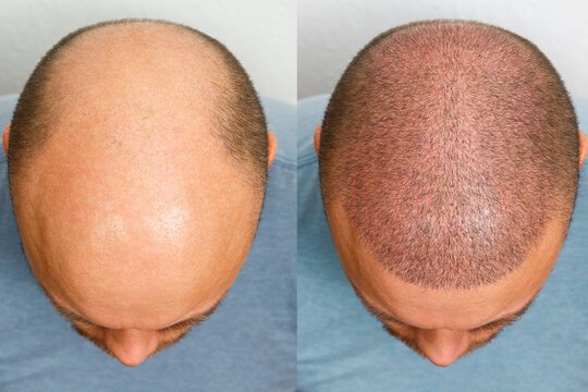 hair transplant treatment greater noida