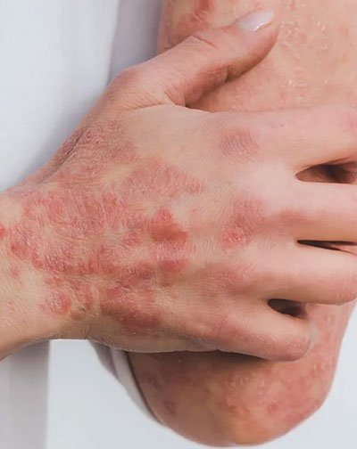 Psoriasis