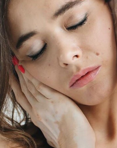 Pigmentation disorders