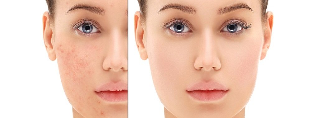 Pigmentation Removal Treatment in Greater Noida | Pigmentation Removal Treatment near me